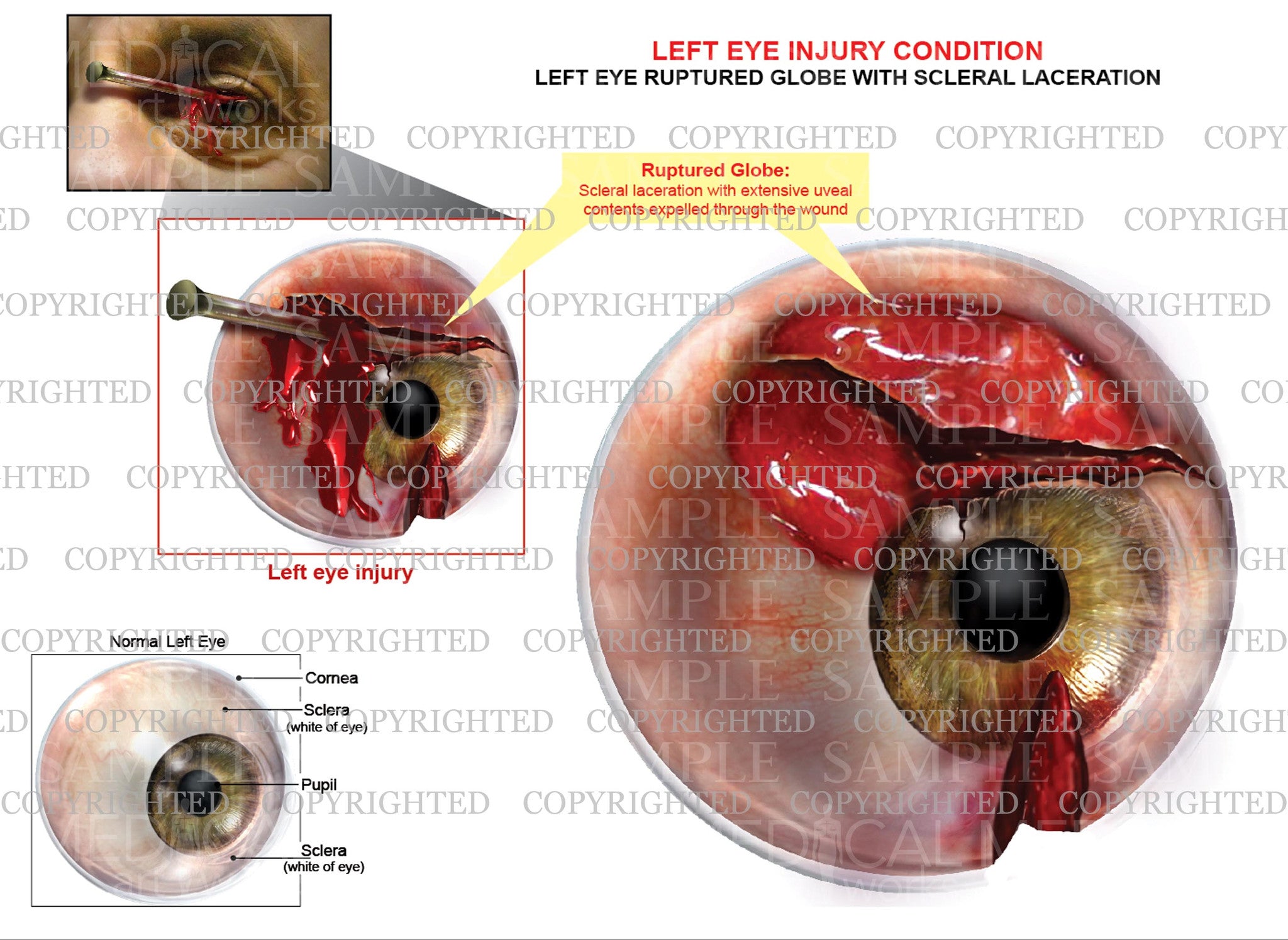 Common Eye Injuries | Eye Society - Eye Care Clinic in Chicago, IL